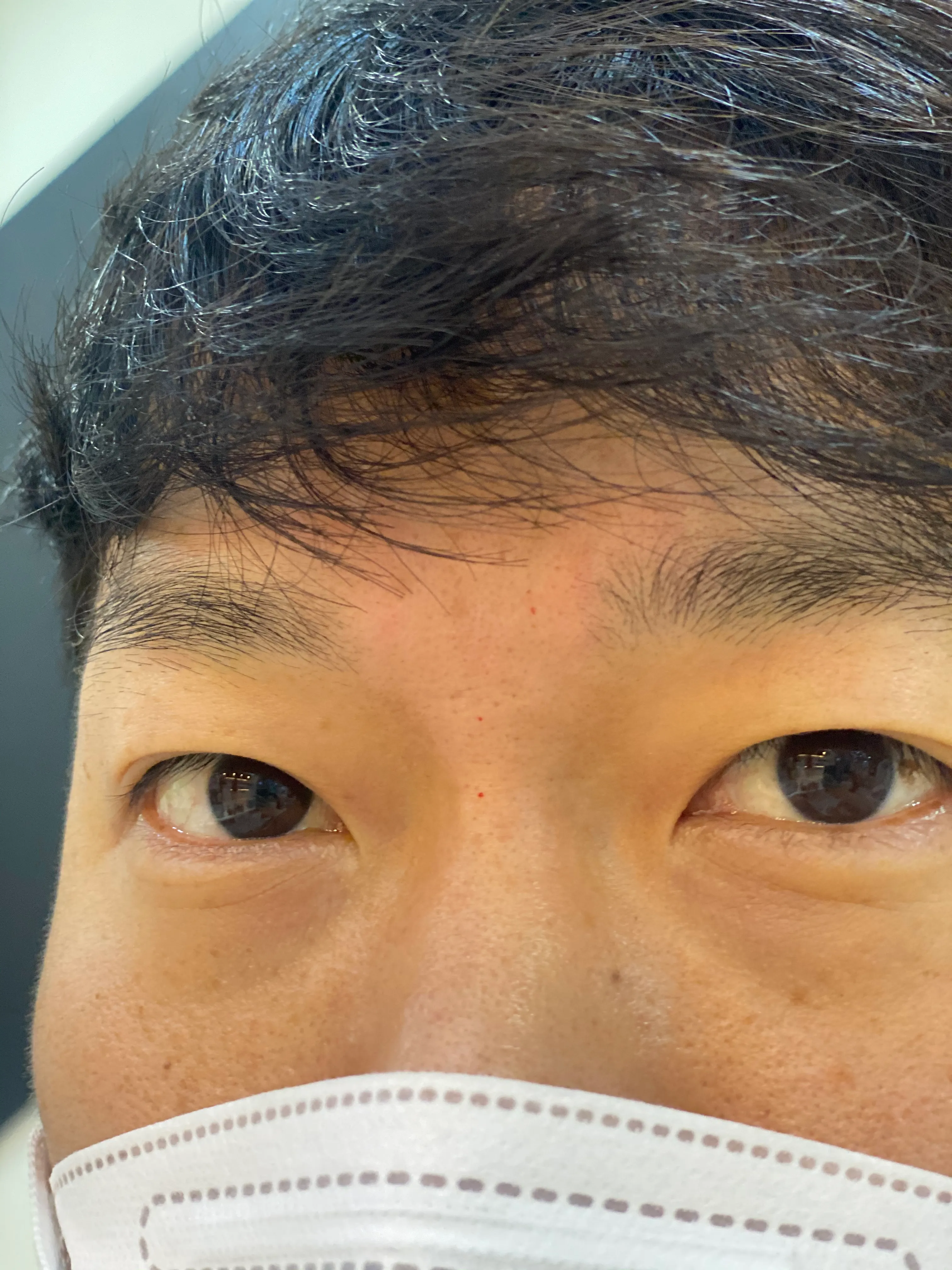 시술 후 — 미케이 주름&사각턱 보톡스