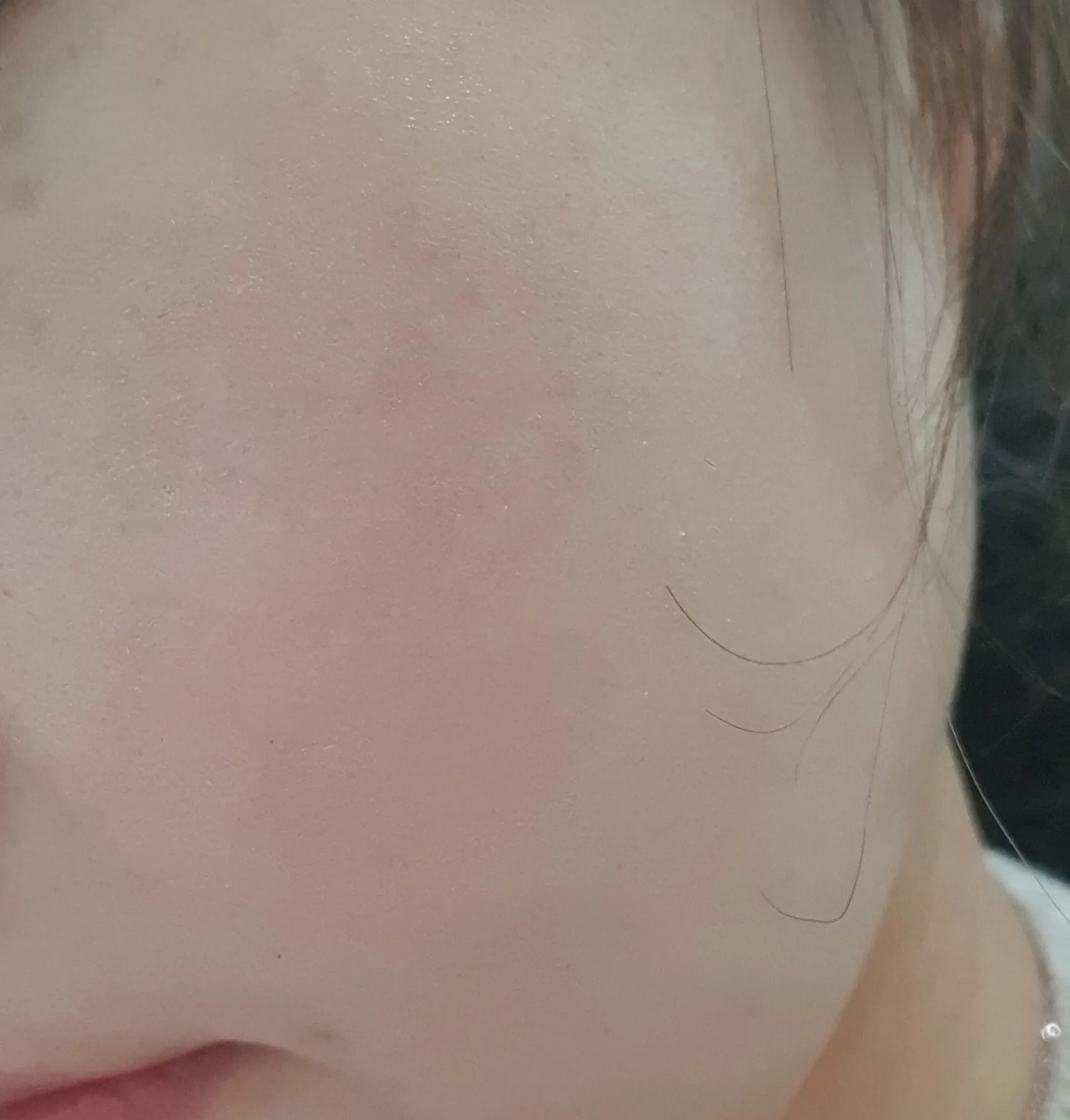 Before treatment — ★ Rejuran Healer 7.9 ★ Pore Reduction, Skin