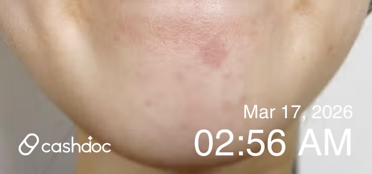 서초구 나인피부과의원, 주사 후 착색 주의하세요