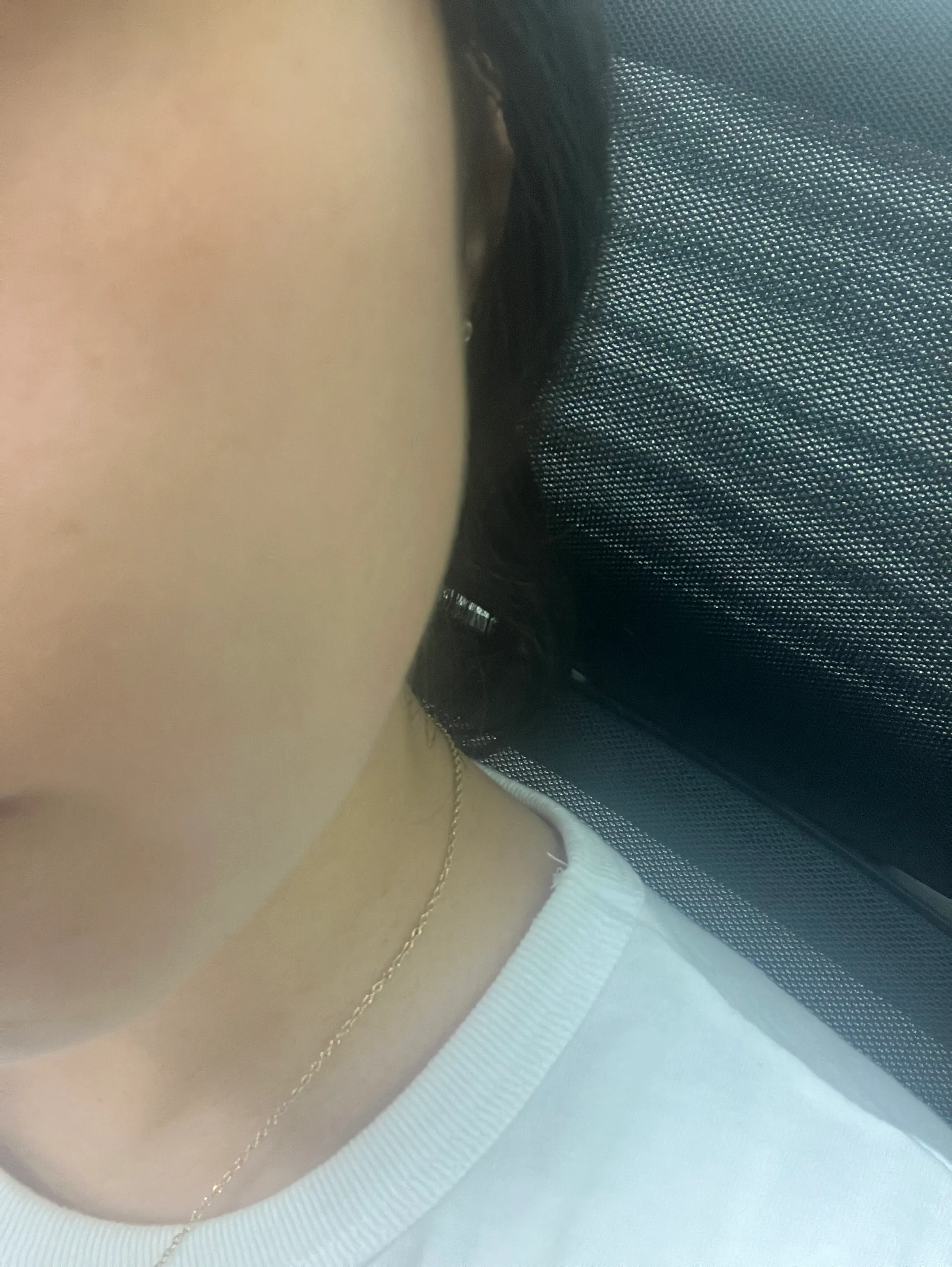 시술 전 — [잡티지우개]에이톤레이저