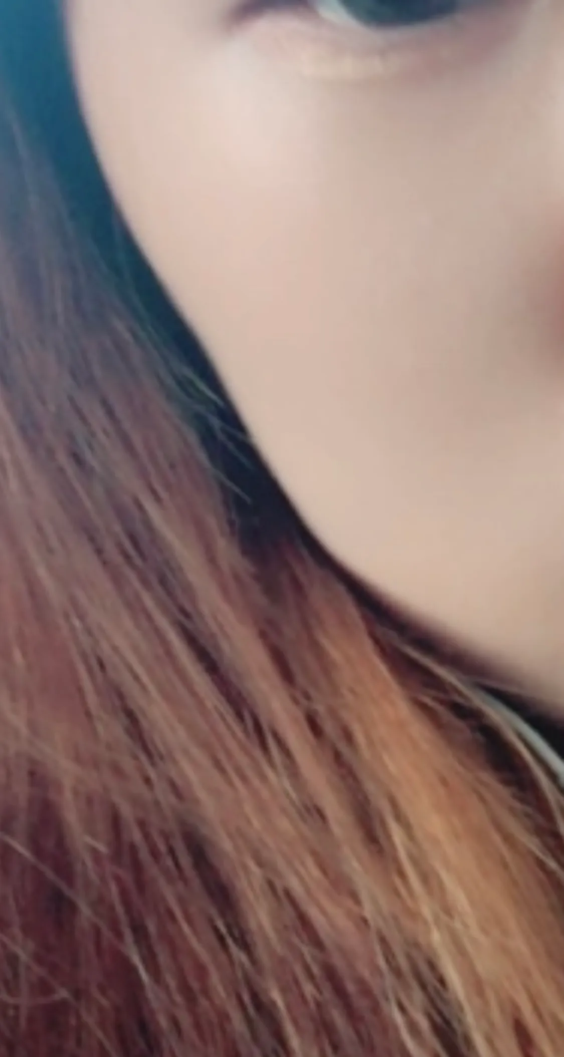 시술 전 — 인모드 리프팅