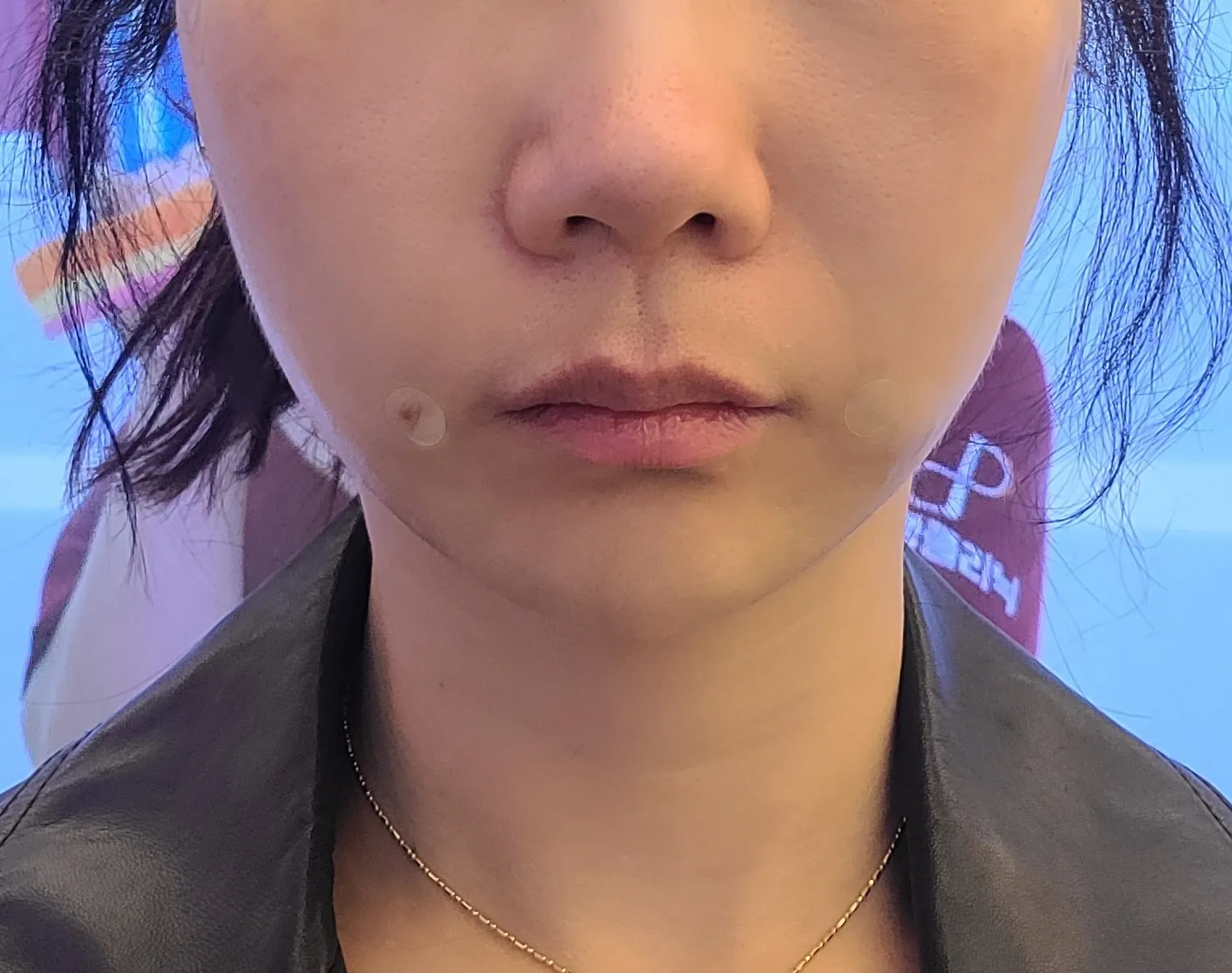 시술 후 — 어려지는 동안 실리프팅
