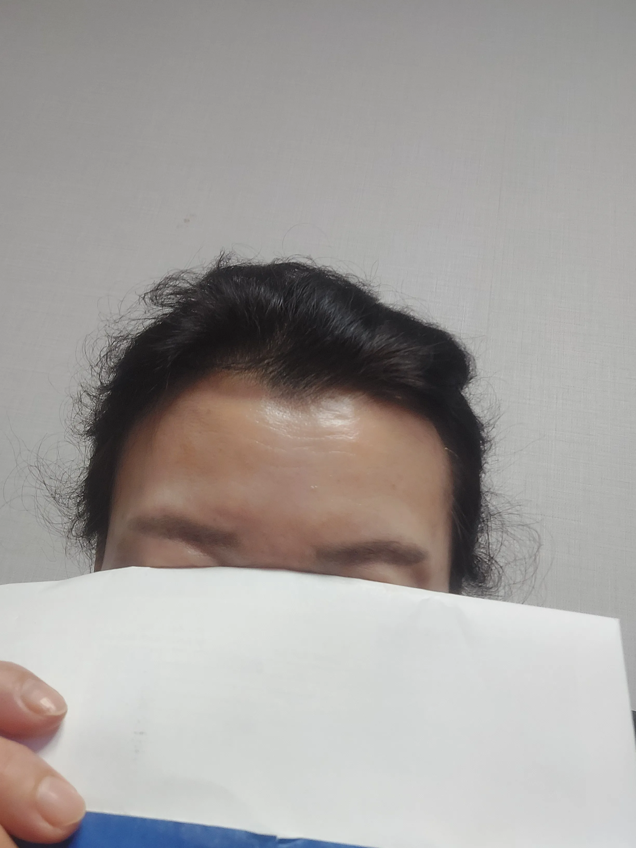 시술 후 — 일산) V라인 만드는 인모드 리프팅