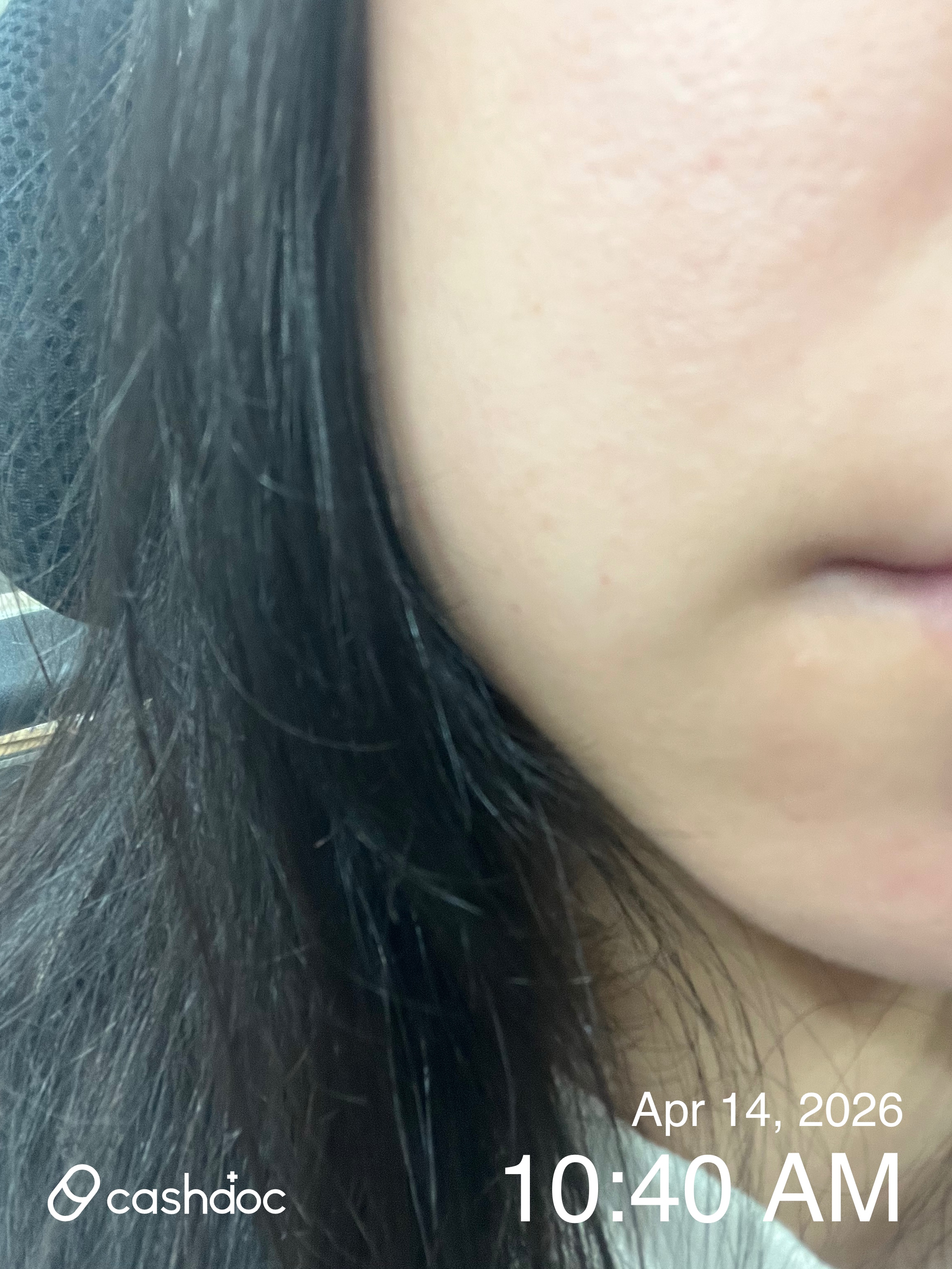 유성구 아이워너비의원, 스테로이드 없는 GPC 주사 후기