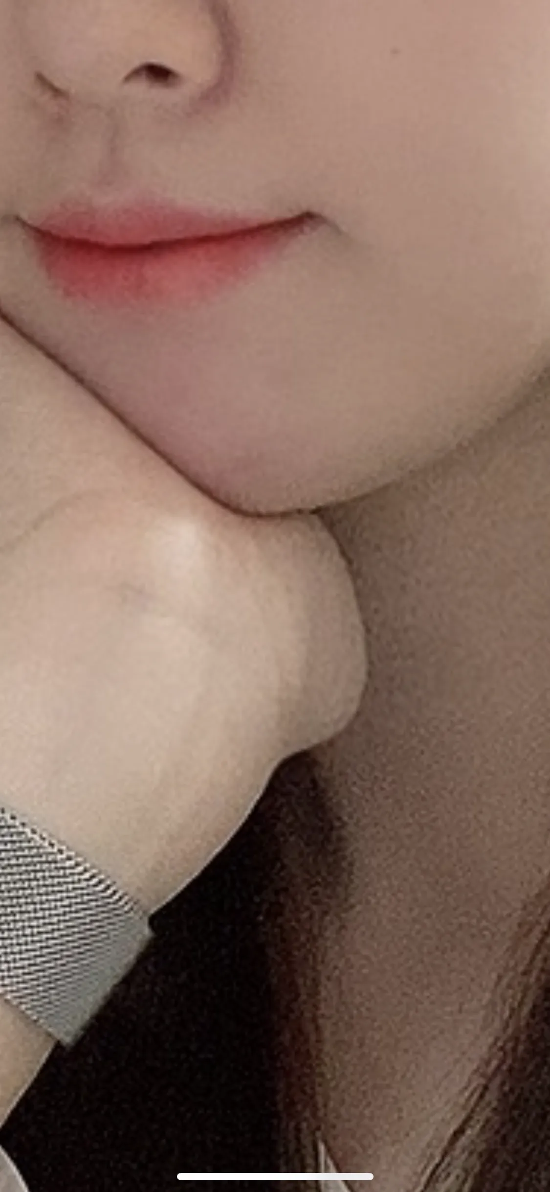 시술 후 사진