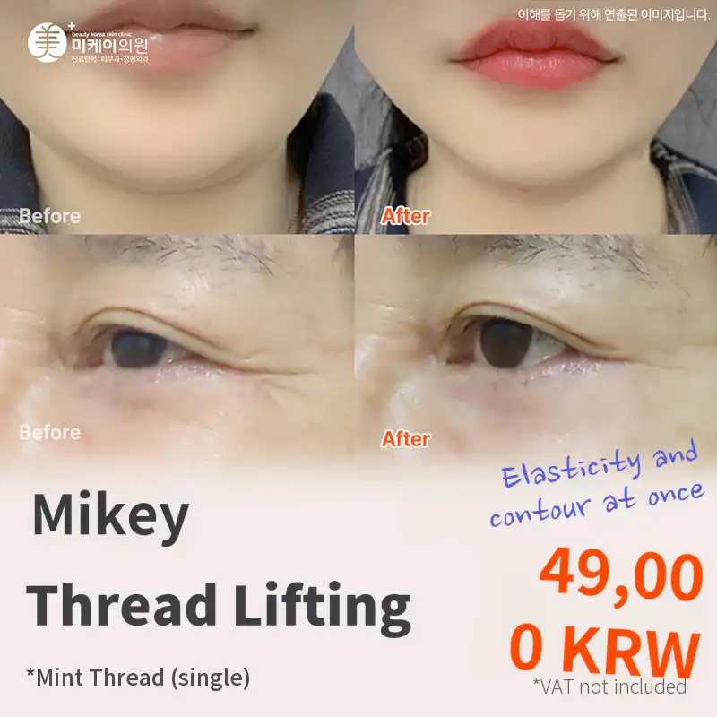 MiK Mint Thread Lifting for Youthful Appearance_Nasolabial Folds, Eye Area