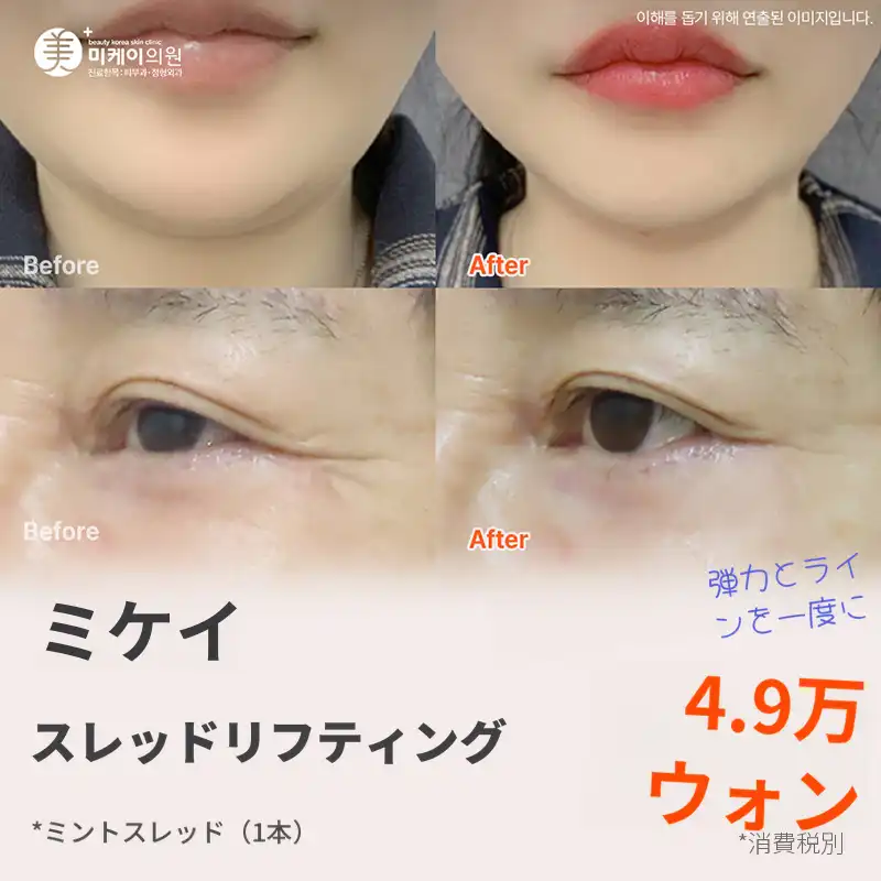 ミケイ ミントスレッドによる若返りリフト_ほうれい線、目元