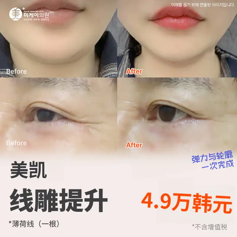 MiK薄荷线提拉_法令纹、眼角