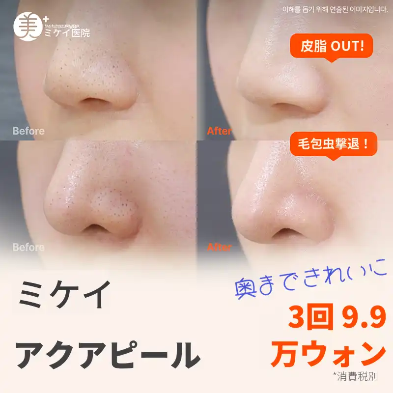 ミケイ 角質＆毛穴清掃_アクアピール