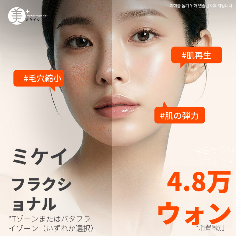 ミケイ毛穴&ニキビ跡改善_フラクセル