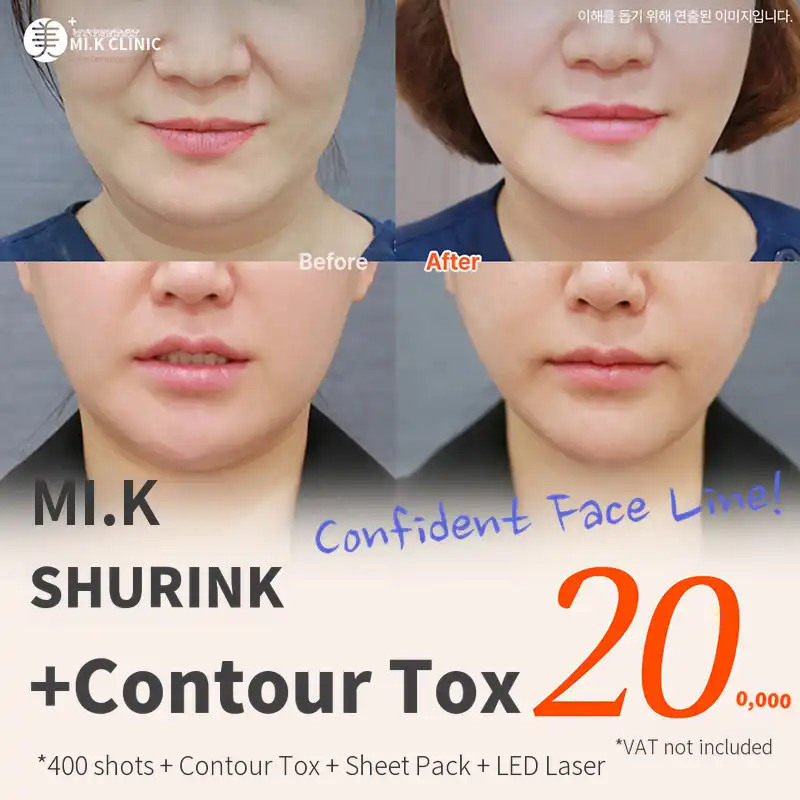 Mikey elasticity improvement with Shrink + contour Botox