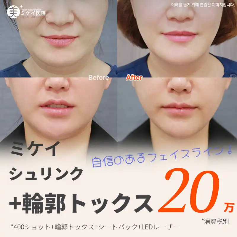 ミケイ弾力改善_シュリンク+輪郭トックス