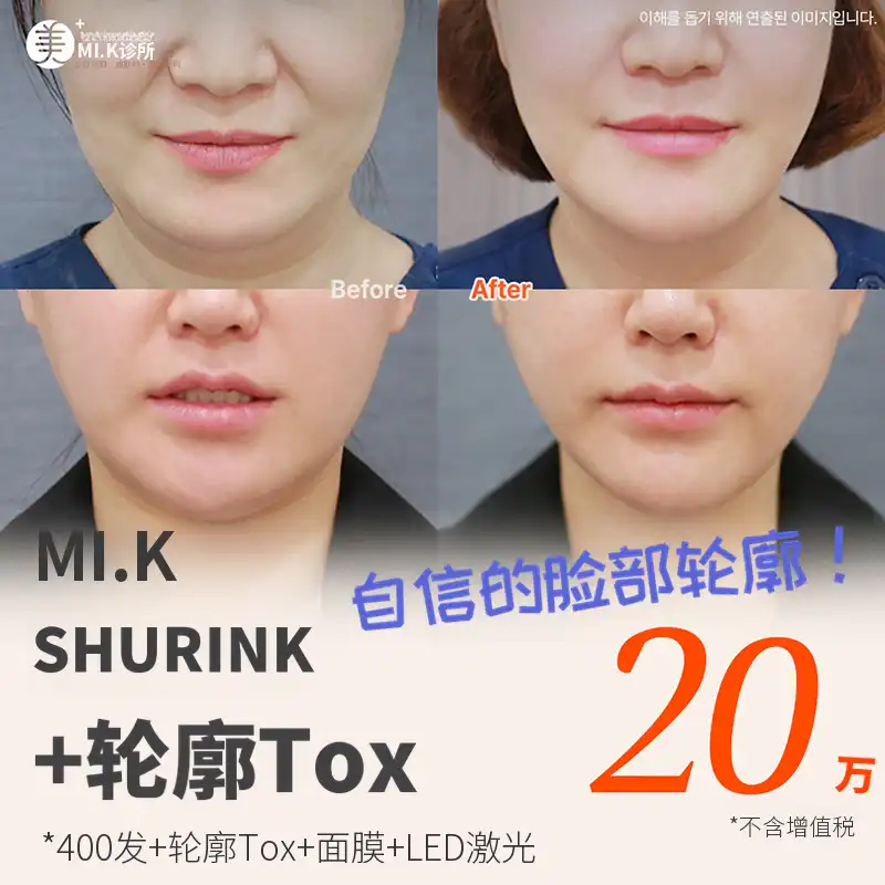 米凯弹力改善_收缩+轮廓肉毒