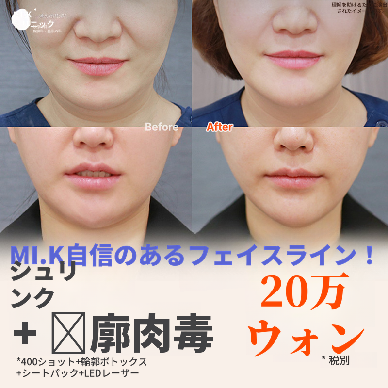 ミケイ弾力改善_シュリンク+輪郭トックス
