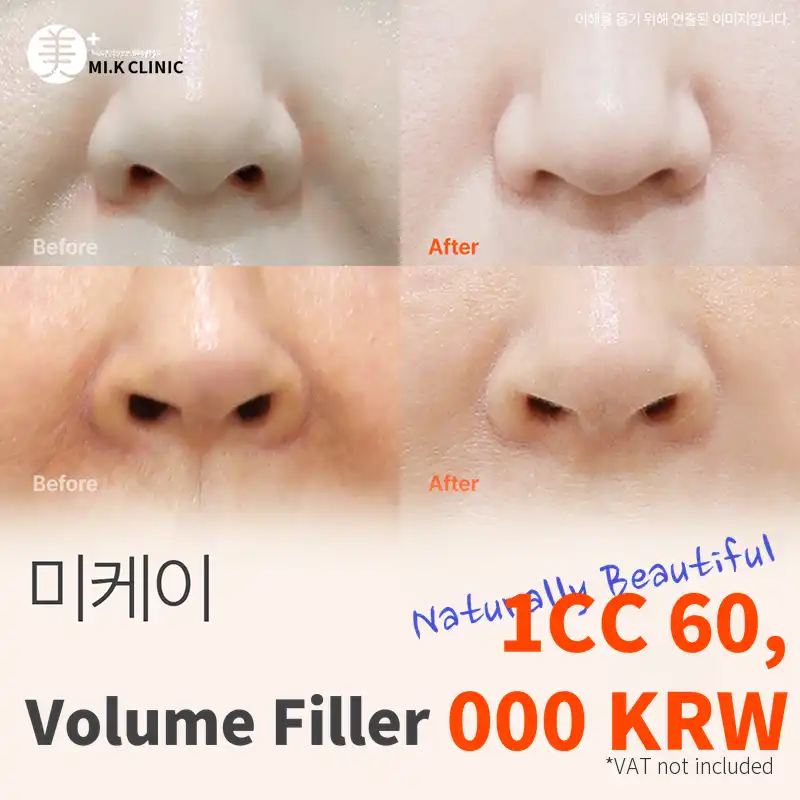 Mikey custom filler for lips, chin, nasolabial folds