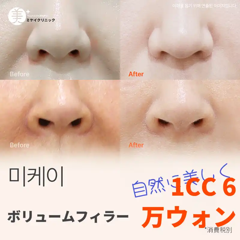 ミケイカスタムフィラー_唇、顎先、ほうれい線