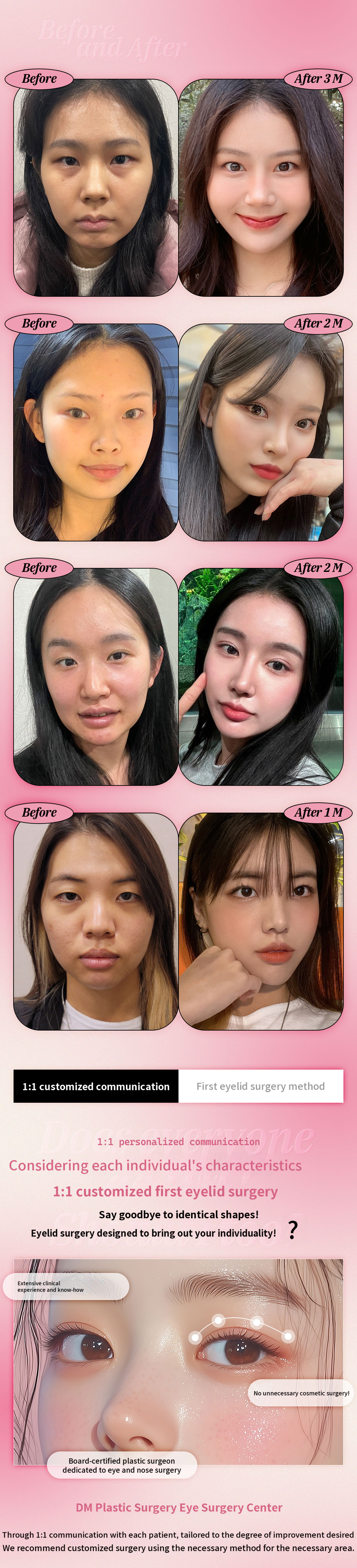 ♥DM♥ Double Eyelid