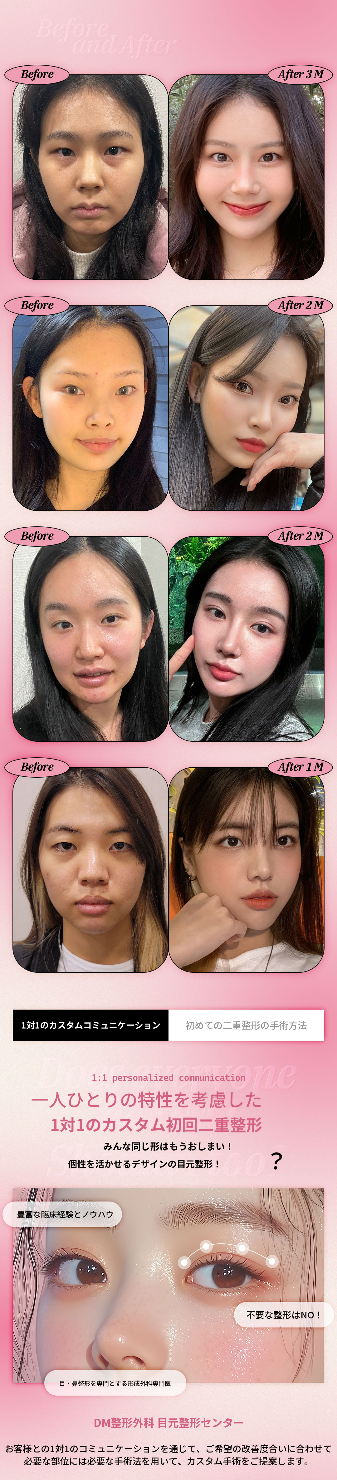 ♥DM♥ 二重まぶた