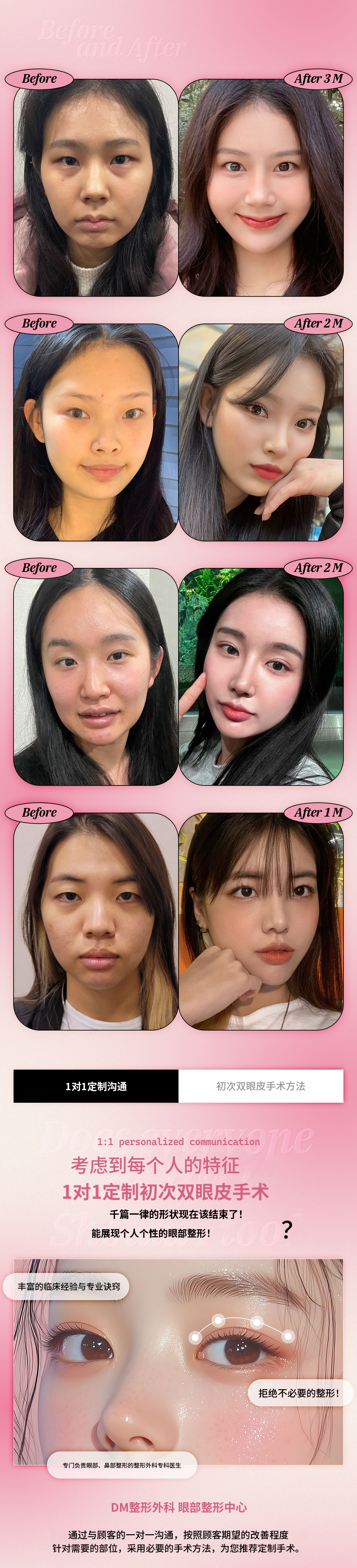♥迪恩♥ 双眼皮