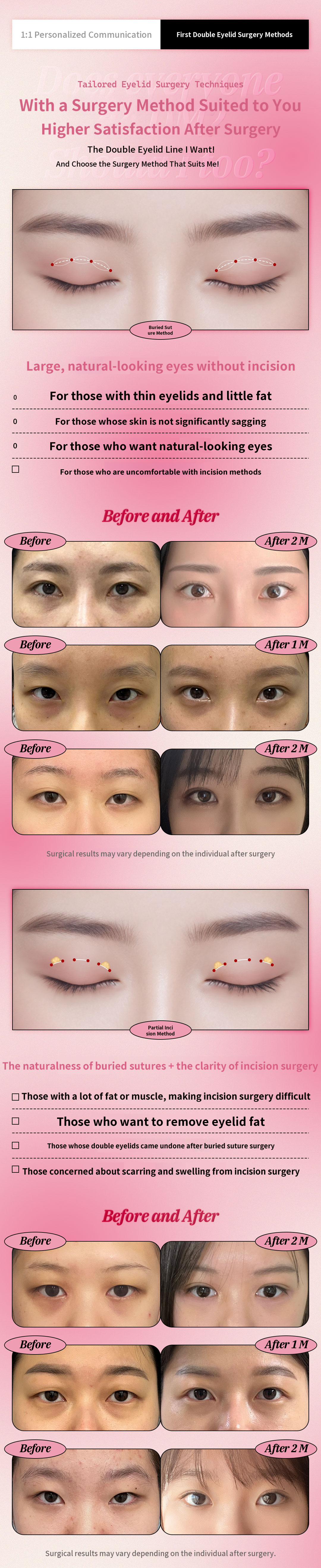 ♥DM♥ Double Eyelid