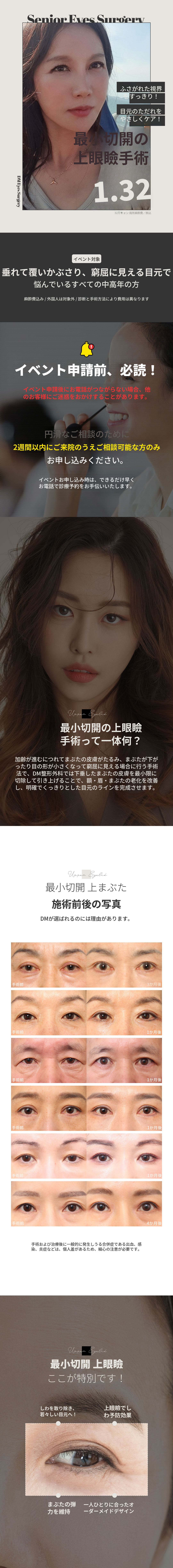 ♥最小切除上眼瞼♥