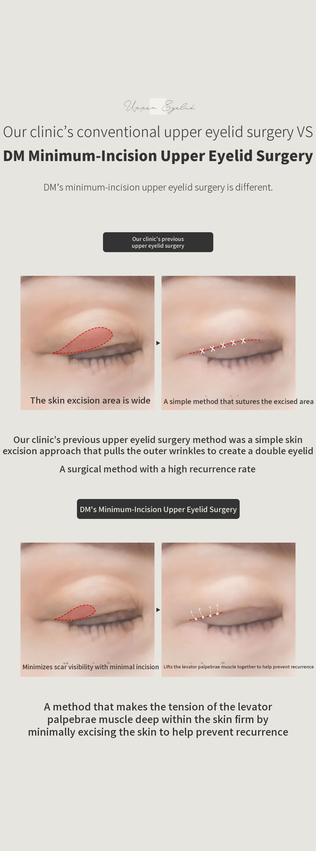 ♥Minimal Invasive Upper Eyelid Surgery♥