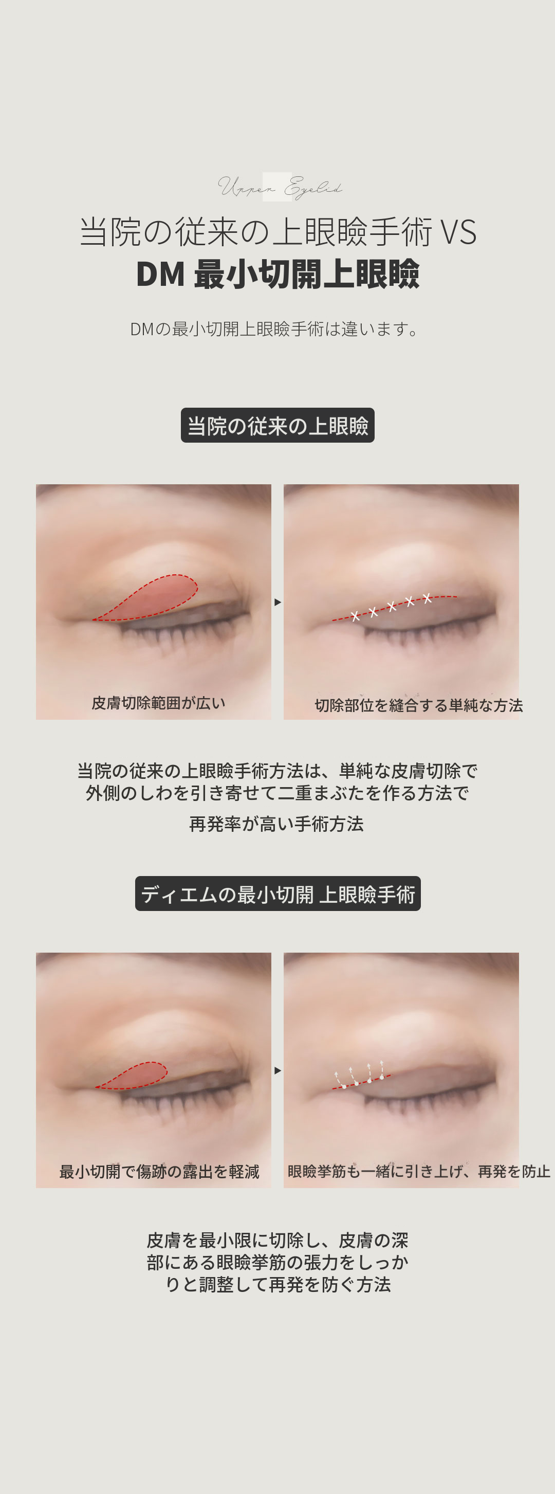 ♥最小切除上眼瞼♥