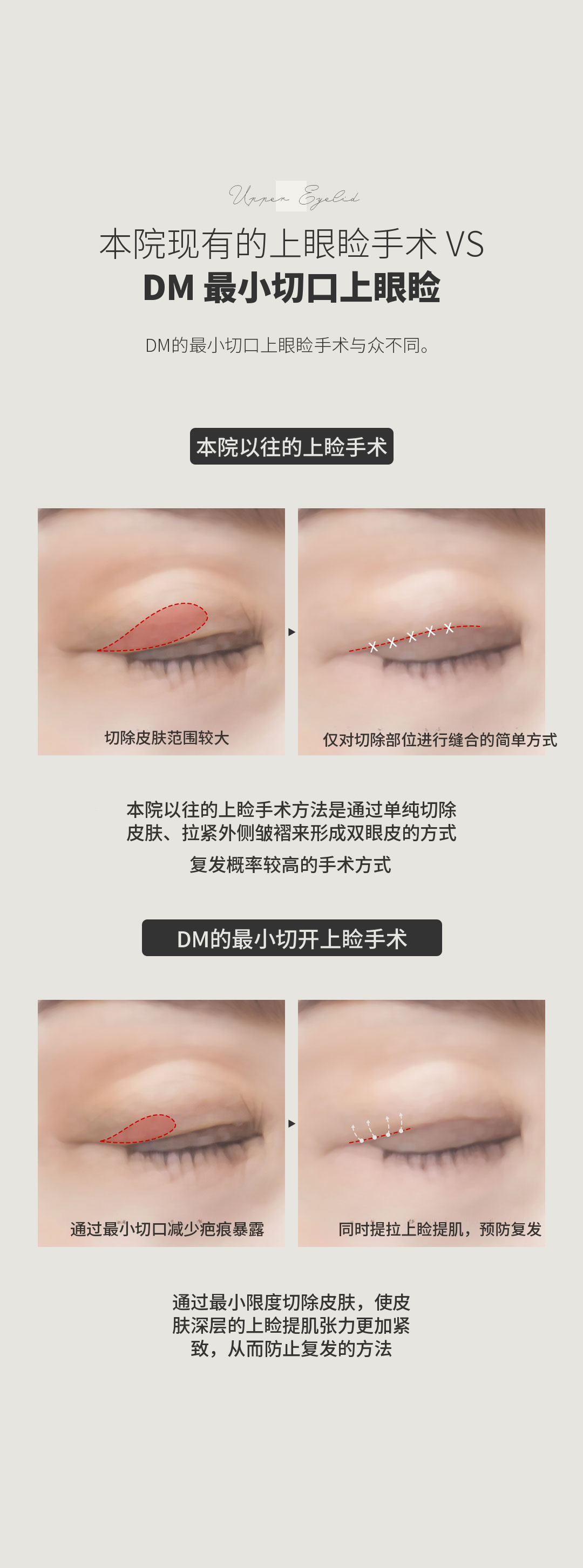 ♥最小切除上眼睑♥