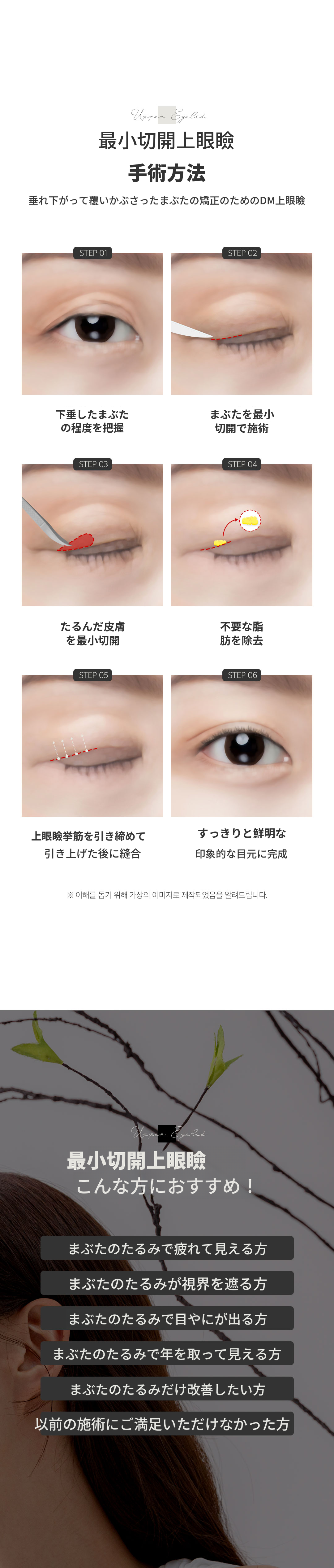 ♥最小切除上眼瞼♥