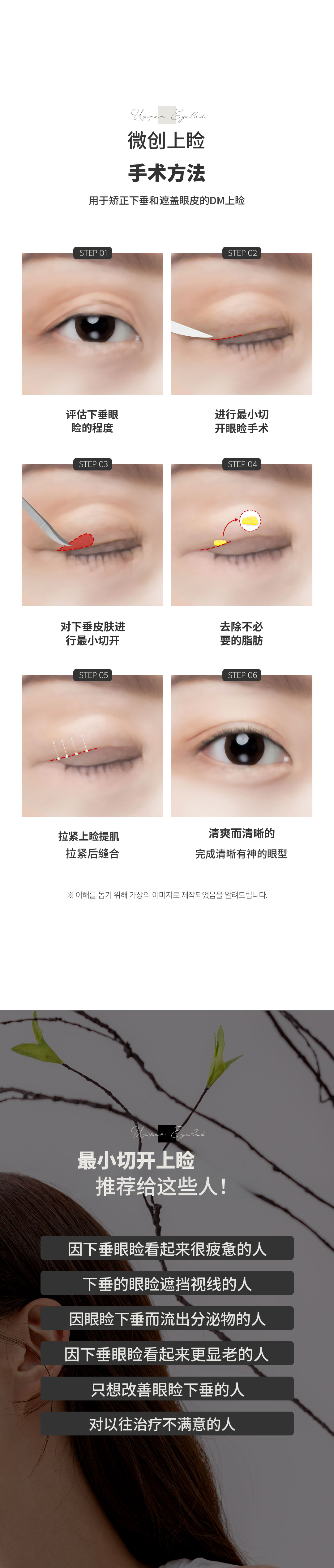 ♥最小切除上眼睑♥