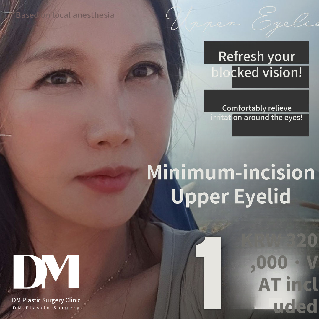 ♥Minimal Invasive Upper Eyelid Surgery♥
