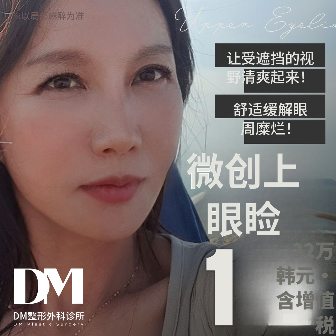 ♥最小切除上眼睑♥