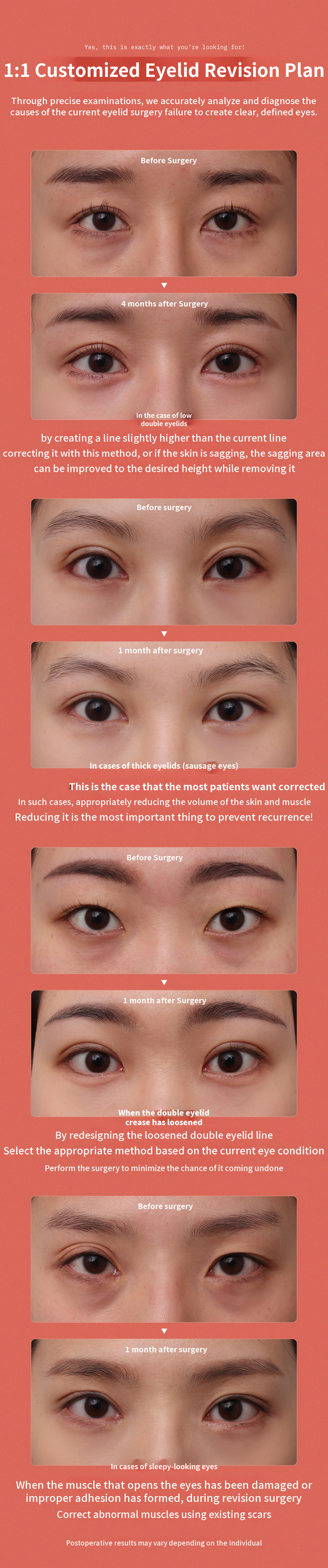 ❤DM❤ Eye Reoperation