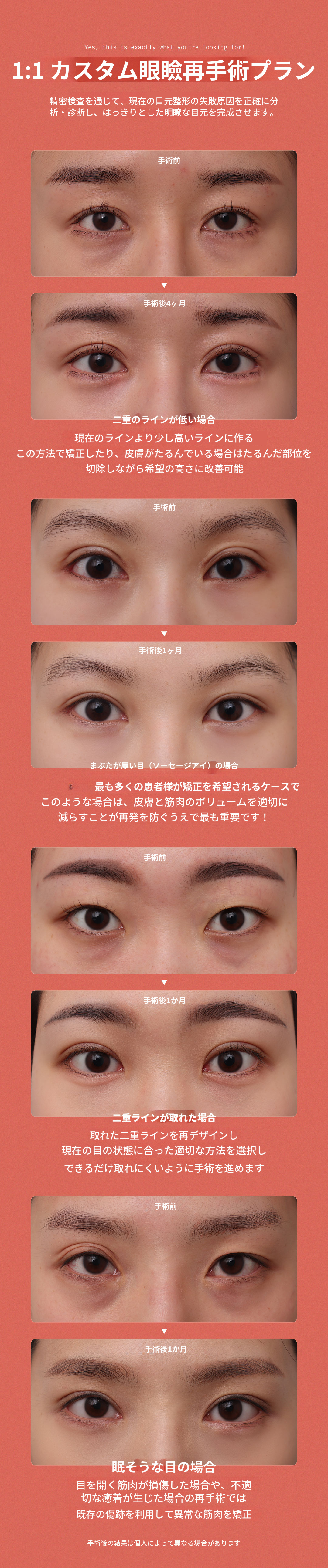 ❤DM❤ 目の再手術