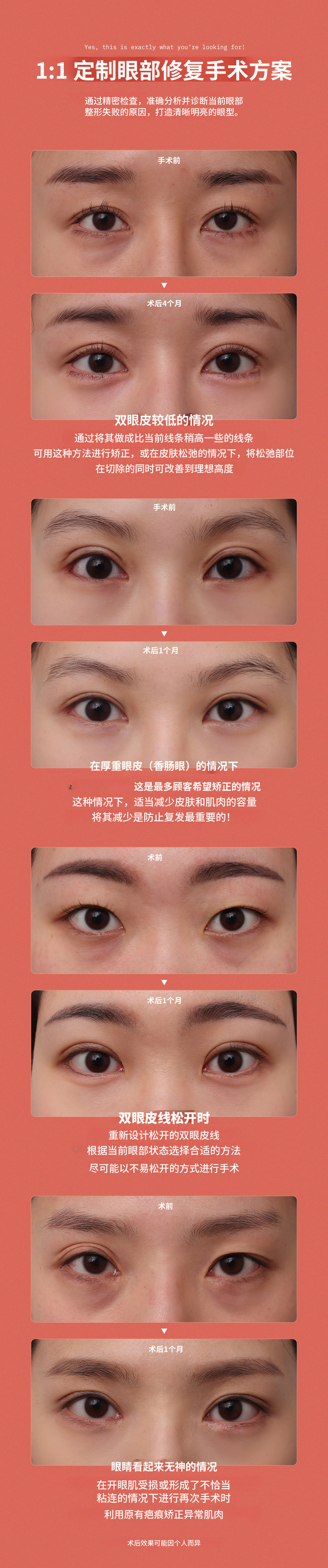 ❤DM❤ 眼部手术