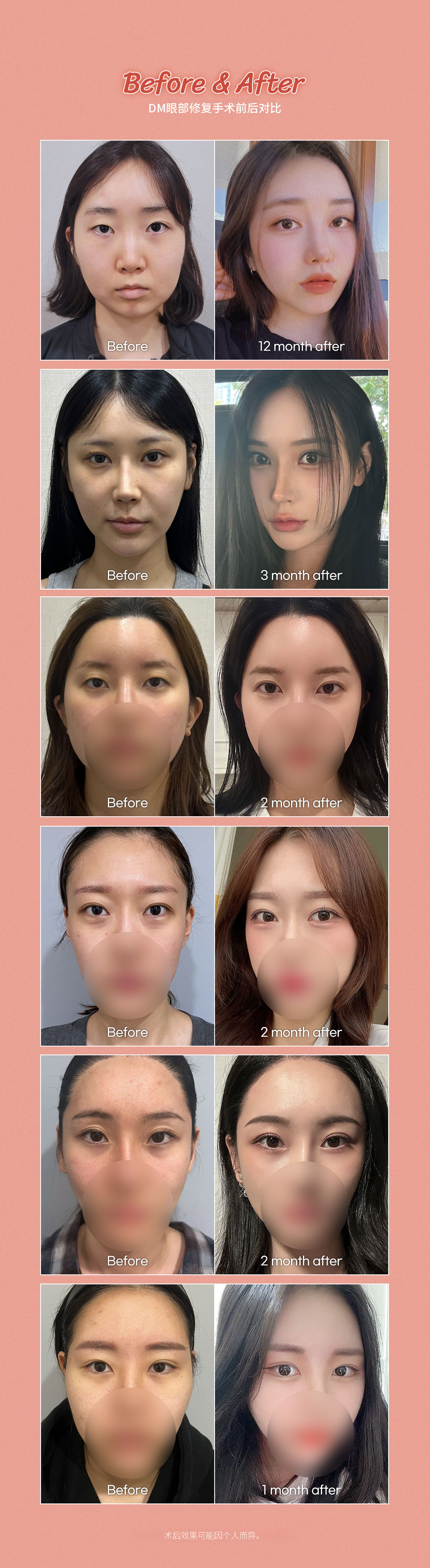 ❤DM❤ 眼部手术
