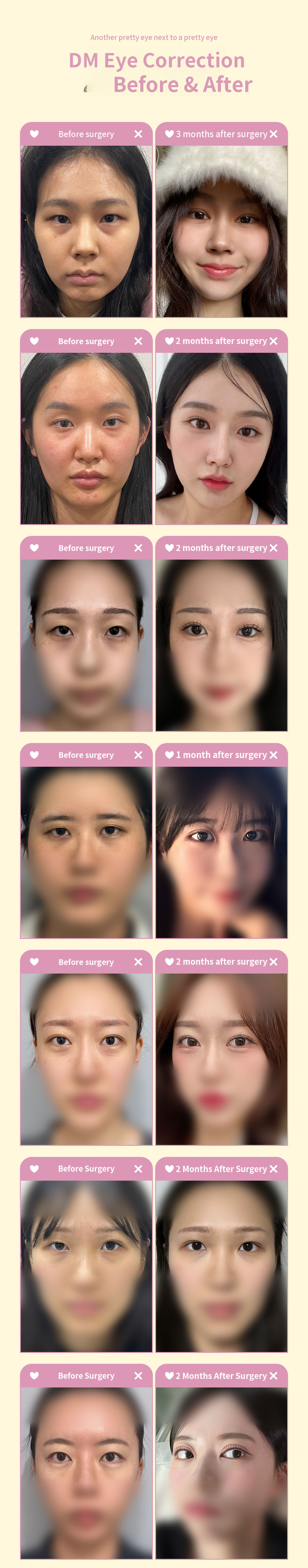 ♥DM Eyelid Correction♥