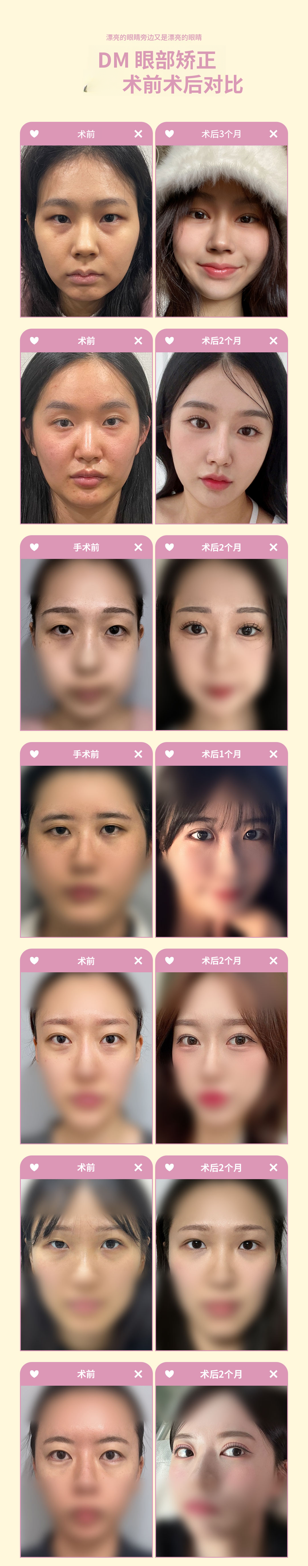 ♥DM眼形矫正♥