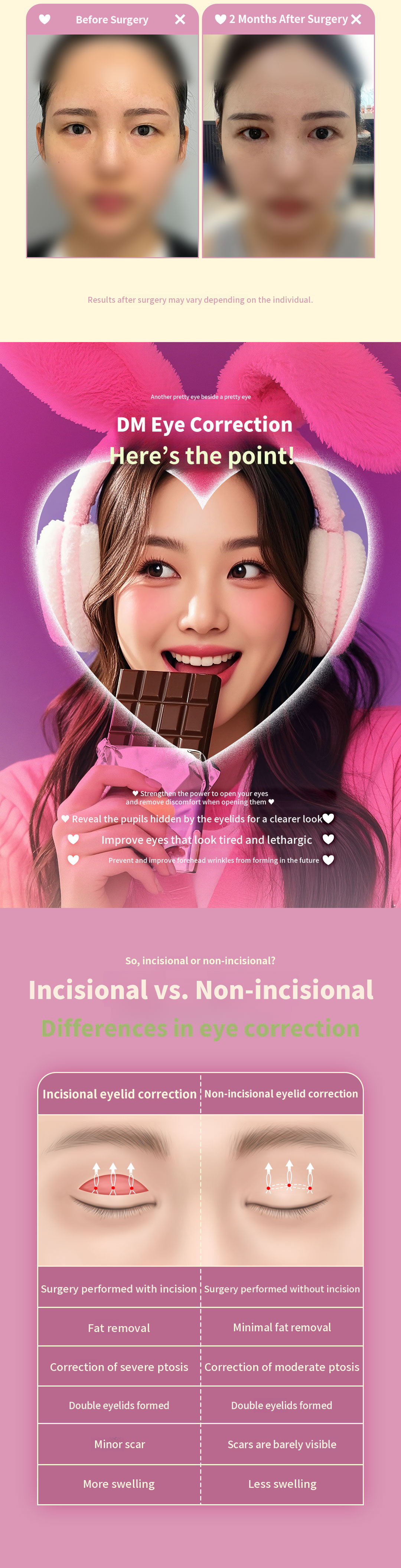 ♥DM Eyelid Correction♥