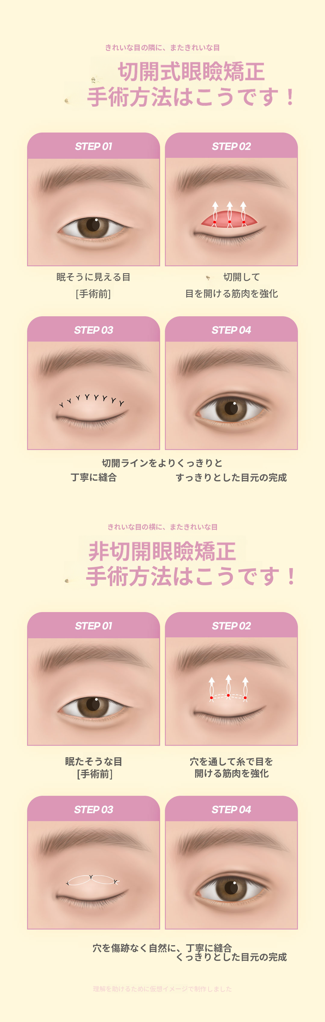 ♥DM目の形矯正♥