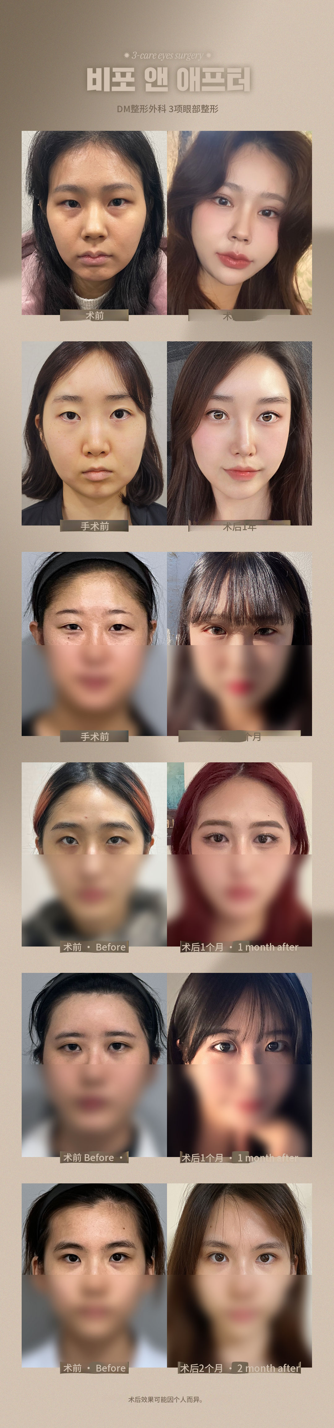 DM三护理眼部整形