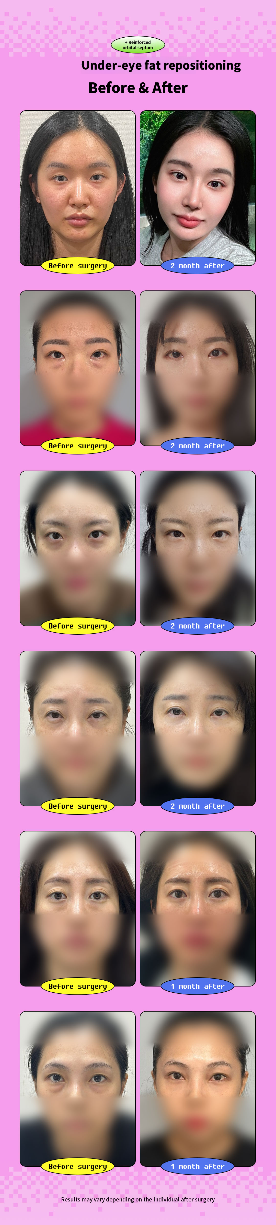 Lower Eyelid Fat Repositioning with Membrane Reinforcement