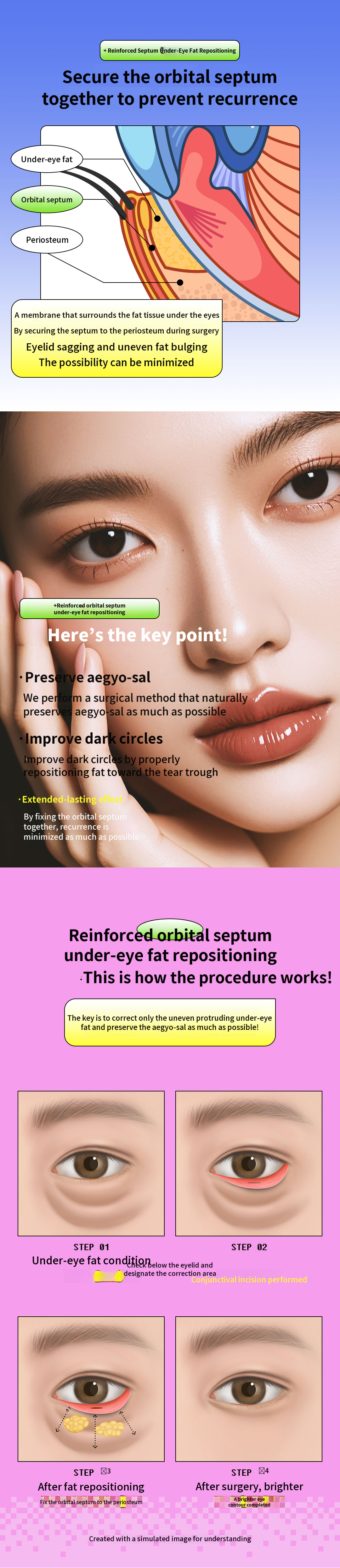 Lower Eyelid Fat Repositioning with Membrane Reinforcement