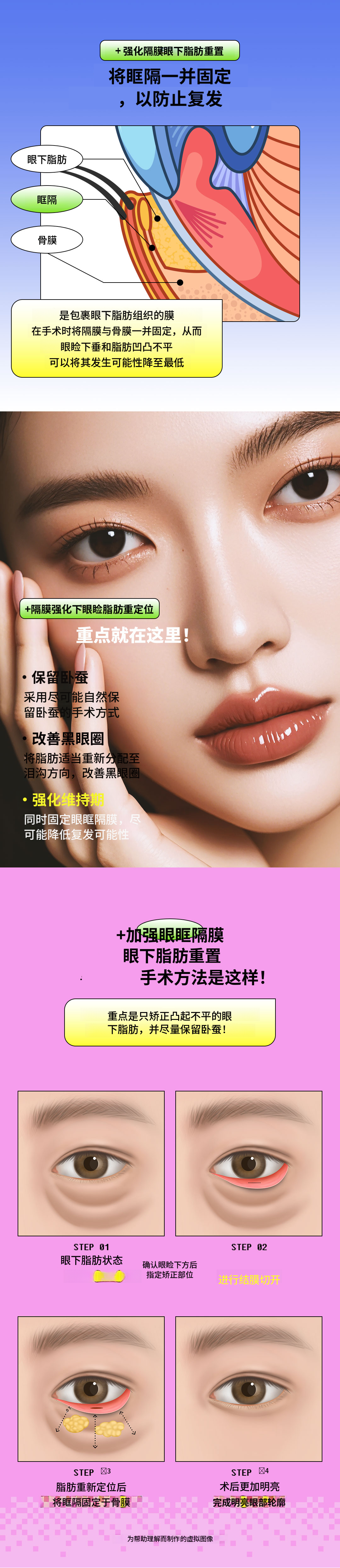 眼袋下脂肪重塑