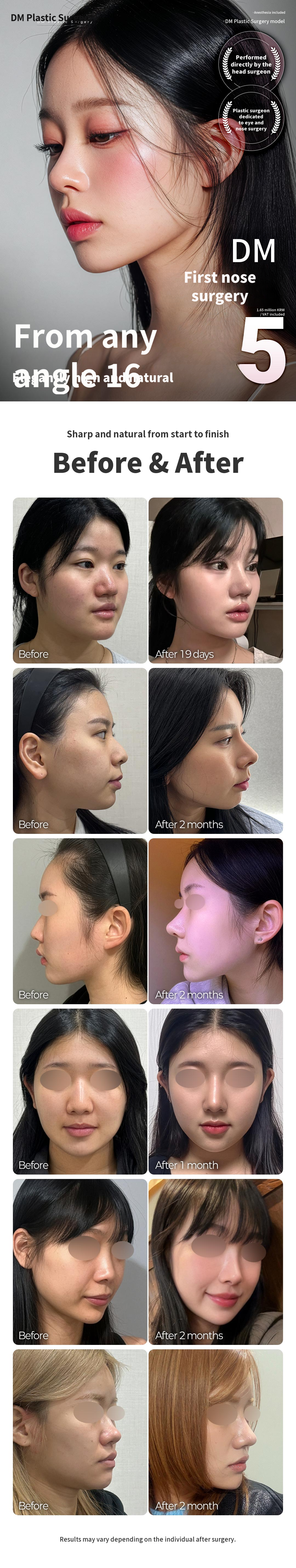 ♥ DM First Rhinoplasty ♥