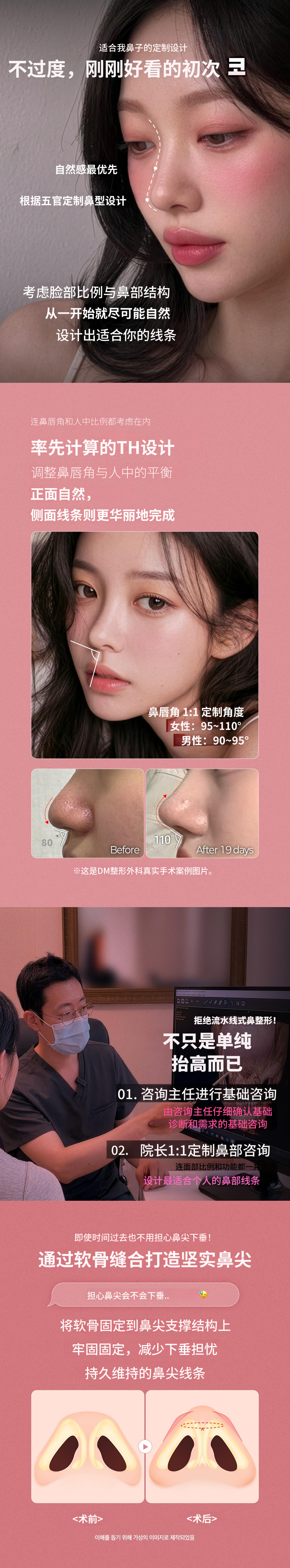 ♥DM首次隆鼻♥