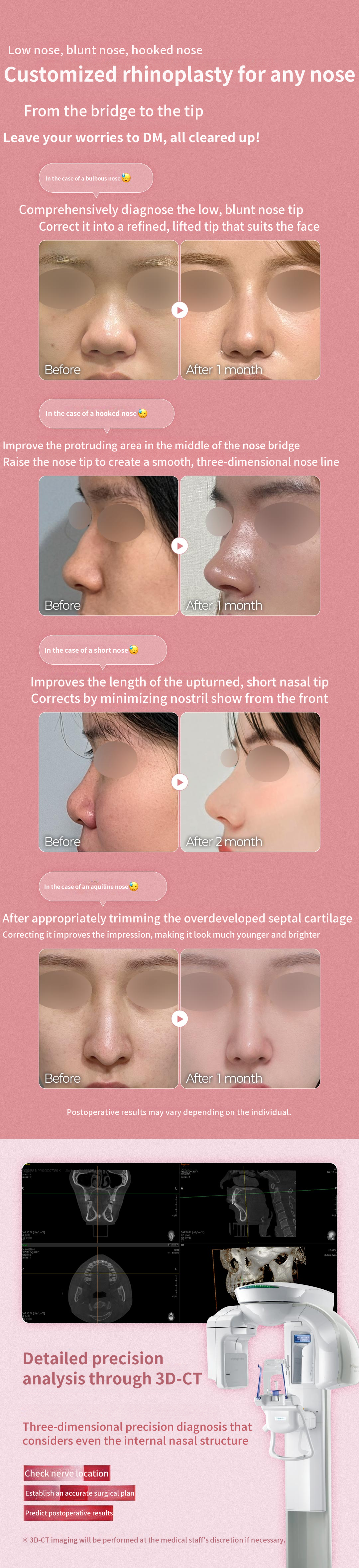 ♥ DM First Rhinoplasty ♥