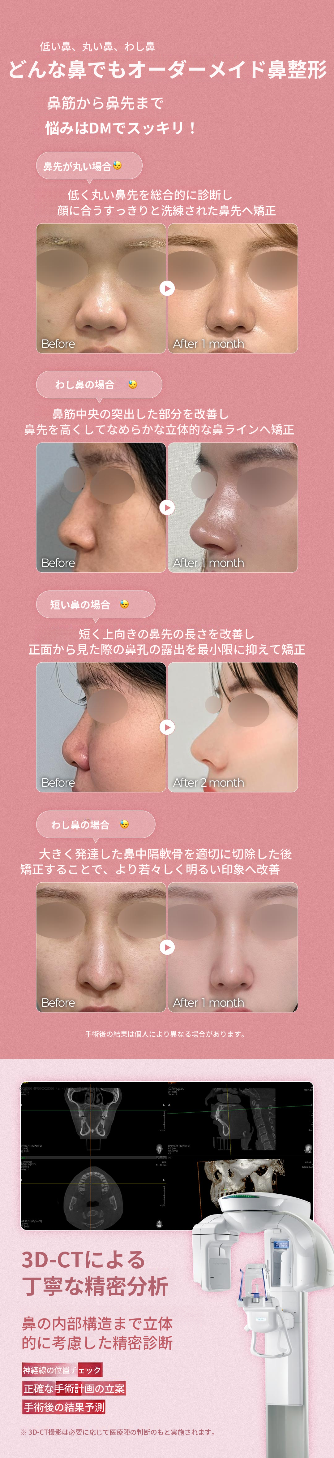 ♥DM初鼻整形♥