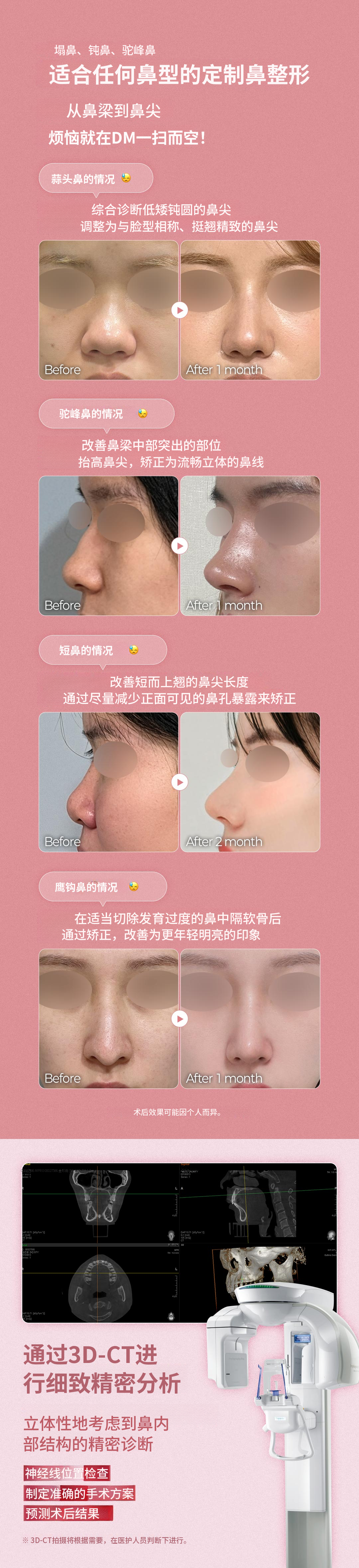 ♥DM首次隆鼻♥