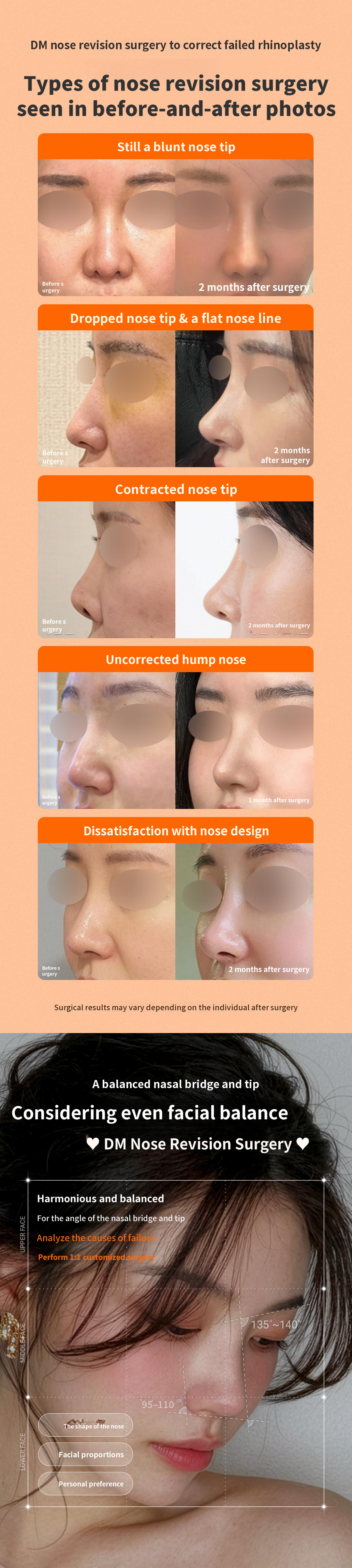 ❤ DM Nose Reshaping Surgery ❤